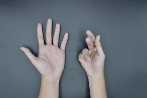 Kramper i hånd som følge af stiff person syndrom