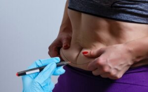 BodyTite: Teknologien til at opstramme kroppen