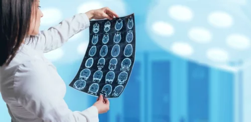 Scanningsbilleder af hjerne er resultatet af cerebral angiografi