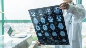 Hvad er en Stroke Unit?