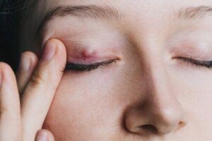 Chalazion: Alt, hvad du behøver at vide