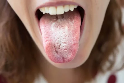 Svamp på tungen kan forårsage hævede smagsløg