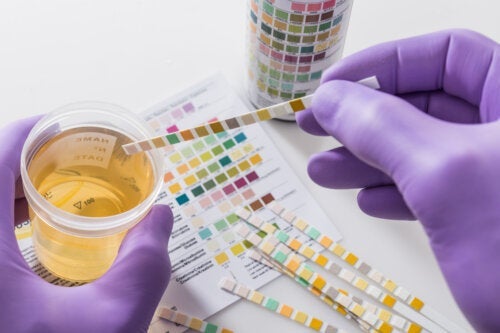Fedt i urinen: Mulige årsager og hvad man skal gøre