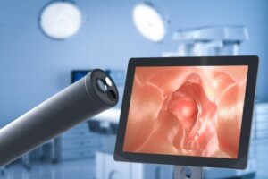Kirurgi til behandling af gastroøsofageal reflukssygdom