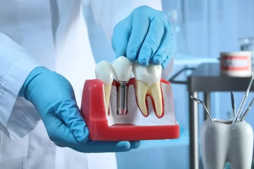 Tandlæge viser en model af osseointegration