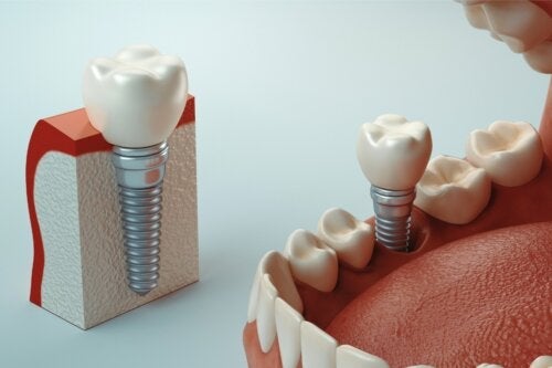 Hvad er osseointegration af tandimplantater?