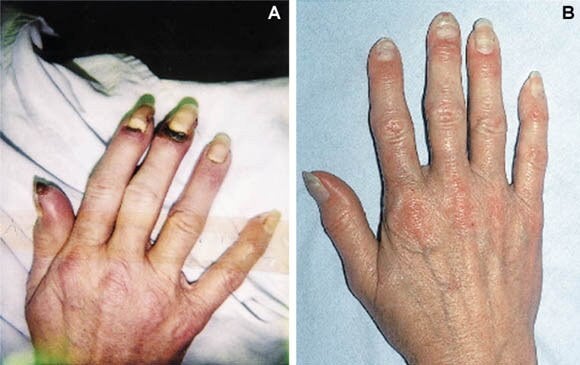 Årsager, symptomer og behandling af Buergers sygdom