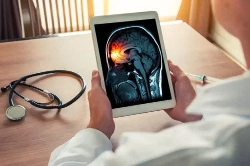Læge med tegning af hjerne med migræne, som kan forårsage kalejdoskopisk syn