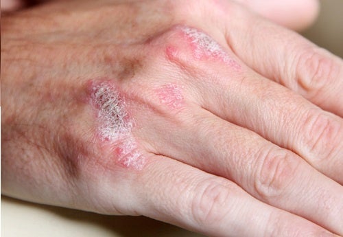 En diæt til psoriasis til at reducere symptomerne