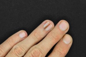 Melanonychia i neglene: Årsager og behandlinger