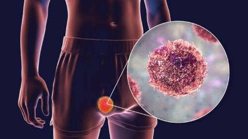 Teratomer: Typer, symptomer og behandling